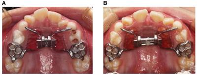 Rapid maxillary expansion treatment increases mid-facial depth in early mixed dentition